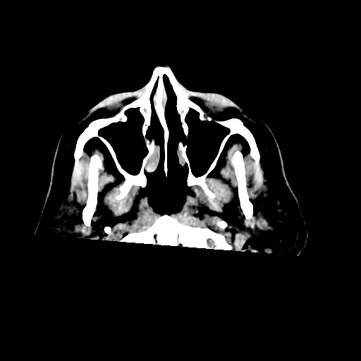 File:Acoustic schwannoma (Radiopaedia 55729-62280 Axial non-contrast 1).png