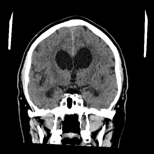 File:Acoustic schwannoma (Radiopaedia 55729-62280 Coronal non-contrast 21).png