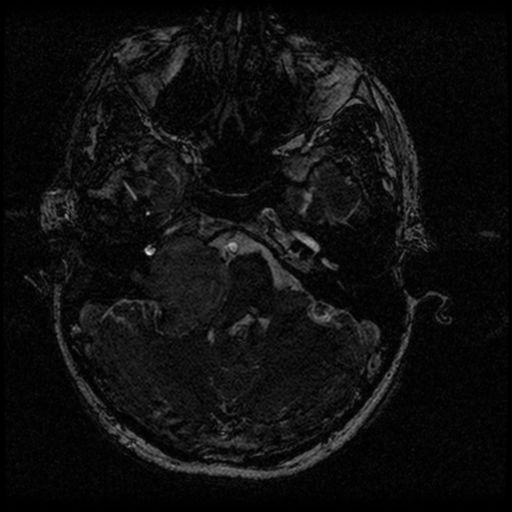 Acoustic schwannoma - eroding petrous apex (Radiopaedia 39674-42004 Axial T2 23).png