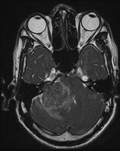 Acoustic schwannoma - probable (Radiopaedia 20386-20292 Axial T1 41).jpg