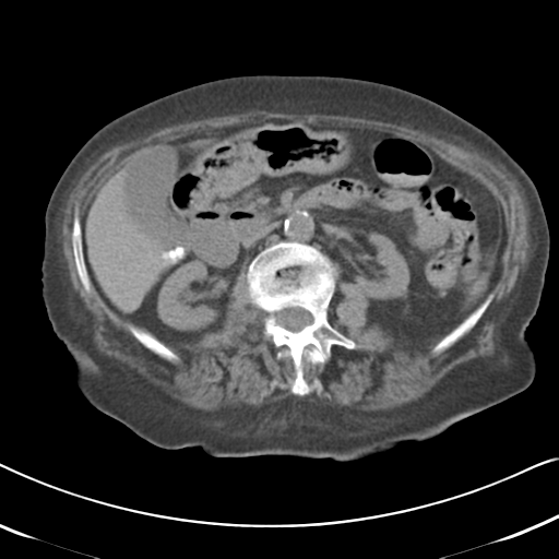 Active bleeding from duodenal ulcer with embolization (Radiopaedia 34216-35481 Axial non-contrast 26).png
