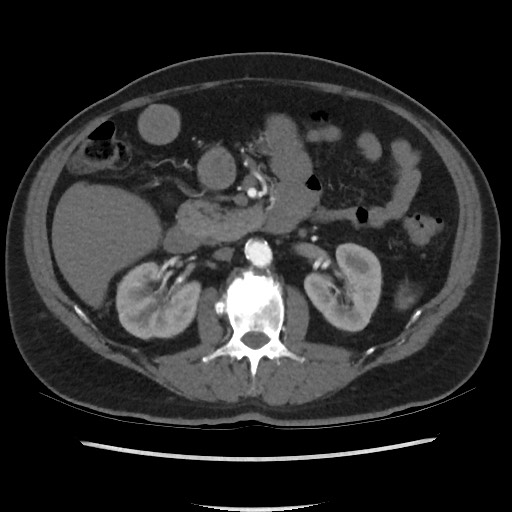 File:Active colonic bleed on CT (Radiopaedia 49765-55025 Axial C+ arterial phase 34).jpg