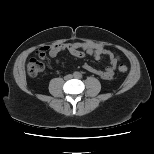 Active colonic bleed on CT (Radiopaedia 49765-55025 Axial non-contrast 50).jpg