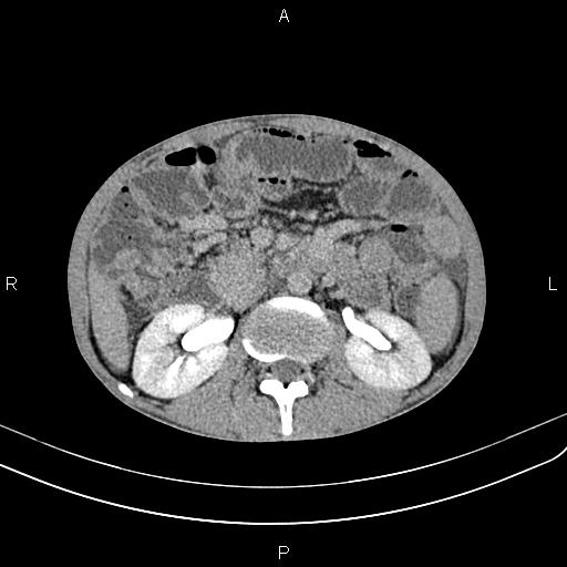 Active crohn disease (Radiopaedia 87133-103397 Axial C+ delayed 21).jpg
