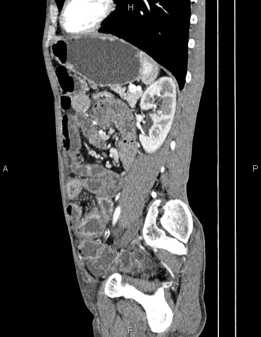 Active crohn disease (Radiopaedia 87133-103397 Sagittal C+ arterial phase 61).jpg