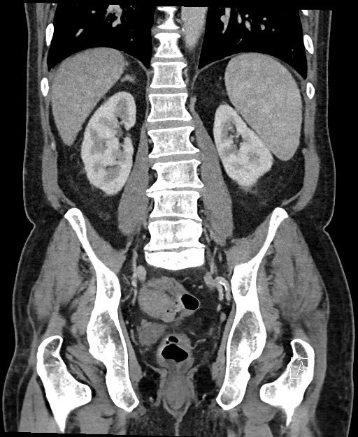 Active lower gastrointestinal bleeding - diverticular (Radiopaedia 61203-69106 Coronal C+ portal venous phase 92).jpg