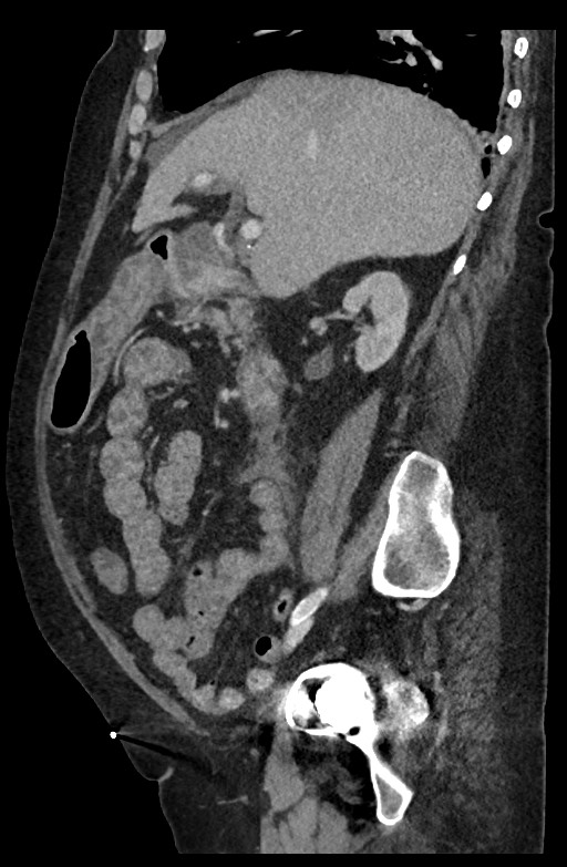 Active renal extravasation with large subcapsular and retroperitoneal hemorrhage (Radiopaedia 60975-68796 Sagittal C+ portal venous phase 144).jpg