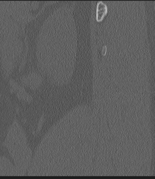 File:Acute L1 burst compression fracture (Radiopaedia 34430-35755 Sagittal bone window 5).png