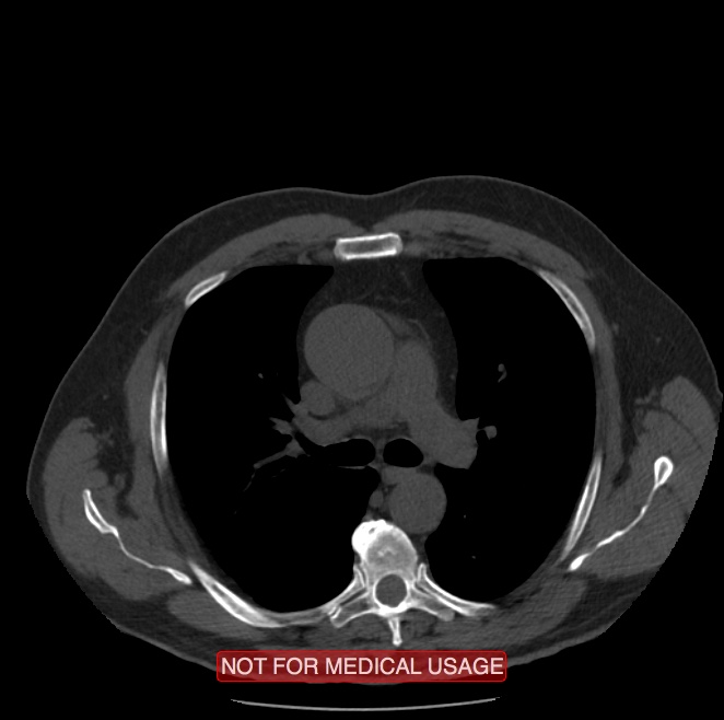 Acute aortic dissection - Stanford type A (Radiopaedia 40661-43285 Axial non-contrast 18).jpg
