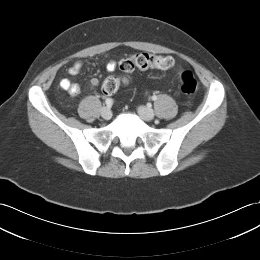 Acute appendicitis (Radiopaedia 30297-30934 Axial C+ portal venous phase 59).jpg