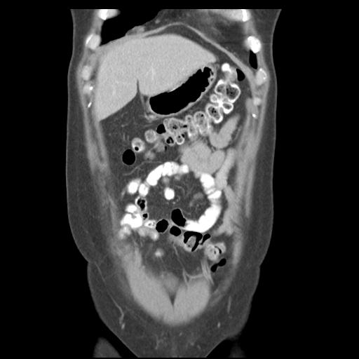 File:Acute appendicitis (Radiopaedia 30297-30934 Coronal C+ portal venous phase 10).jpg