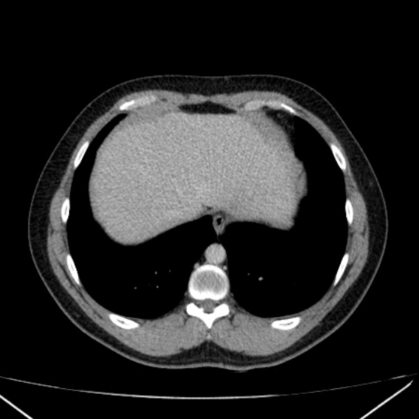 Acute appendicitis (Radiopaedia 38255-40270 Axial C+ portal venous phase 9).jpg