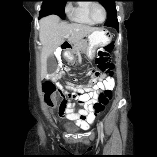 Acute appendicitis (Radiopaedia 52672-58589 Coronal C+ portal venous phase 19).jpg