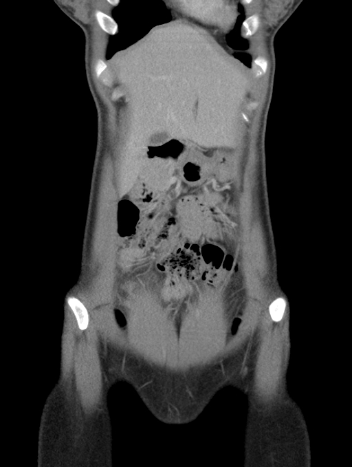 Acute appendicitis (Radiopaedia 62608-70901 Coronal C+ portal venous phase 5).jpg