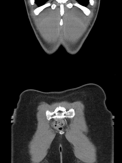 Acute appendicitis (Radiopaedia 62608-70901 Coronal C+ portal venous phase 61).jpg