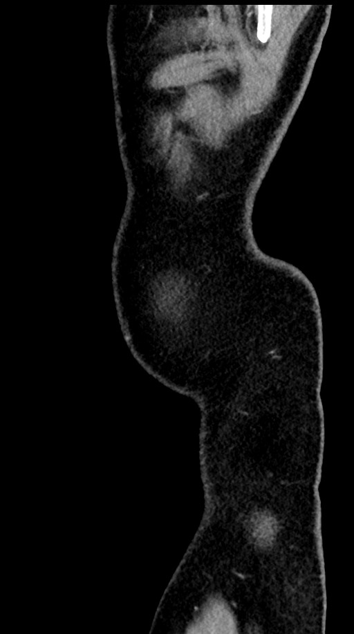 Acute appendicitis (Radiopaedia 77016-88960 Sagittal C+ portal venous phase 4).jpg