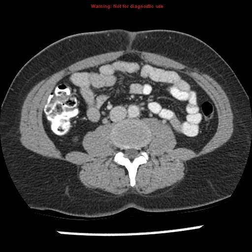 File:Acute appendicitis (Radiopaedia 7966-8812 C+ portal venous phase 25).jpg