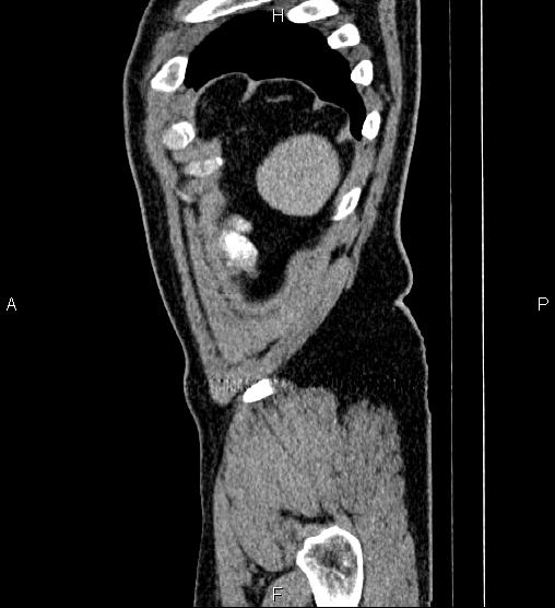 Acute appendicitis (Radiopaedia 84780-100240 Sagittal C+ portal venous phase 101).jpg
