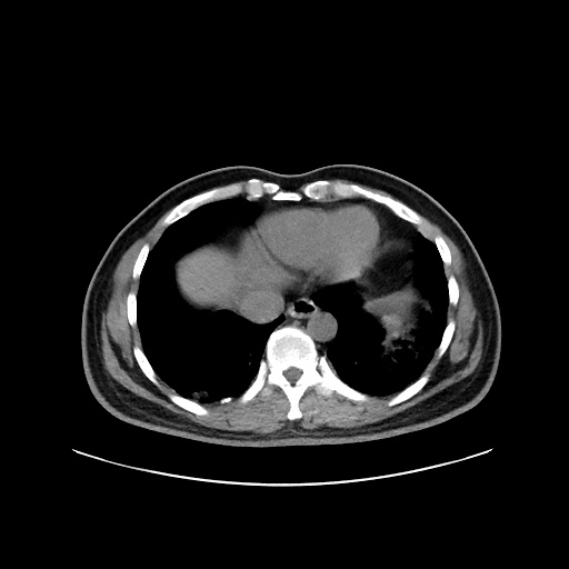 Acute appendicitis and COVID 19 pneumonia (Radiopaedia 76604-88380 Axial non-contrast 43).jpg