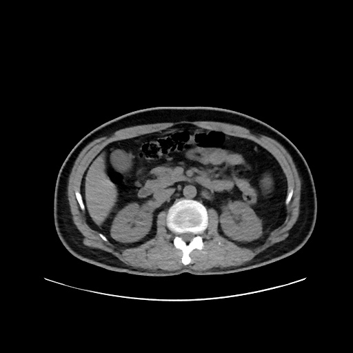 Acute appendicitis and COVID 19 pneumonia (Radiopaedia 76604-88380 Axial non-contrast 68).jpg