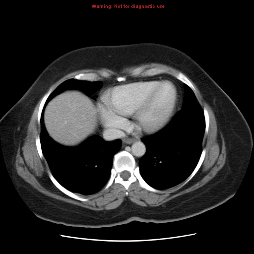 Acute appendicitis complicated by ovarian vein thrombophlebitis (Radiopaedia 16172-15851 Axial C+ portal venous phase 13).jpg
