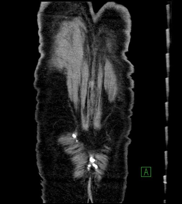 Acute arterial mesenteric ischemia (Radiopaedia 78238-90828 Coronal C+ portal venous phase 86).jpg