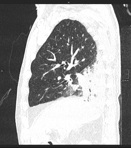 Acute aspiration pneumonitis (Radiopaedia 55642-62166 Sagittal lung window 105).jpg
