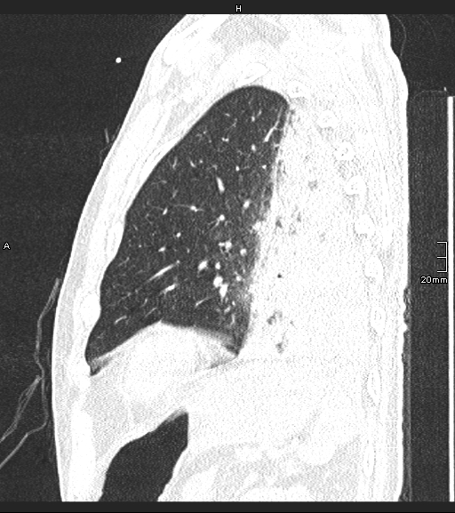 Acute aspiration pneumonitis (Radiopaedia 55642-62166 Sagittal lung window 29).jpg