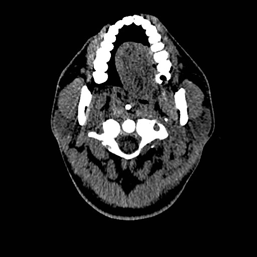 Acute basilar artery occlusion (Radiopaedia 43582-46985 Axial non-contrast 13).jpg
