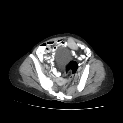 File:Acute calculous cholecystitis in patient with osteopetrosis (Radiopaedia 77871-90159 Axial C+ portal venous phase 66).jpg