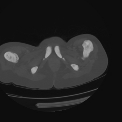 File:Acute calculous cholecystitis in patient with osteopetrosis (Radiopaedia 77871-90159 Axial bone window 53).jpg