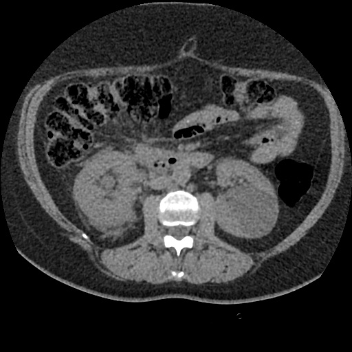 File:Acute cholecystitis and ureteric colic (Radiopaedia 42330-45444 Axial prone 44).jpg