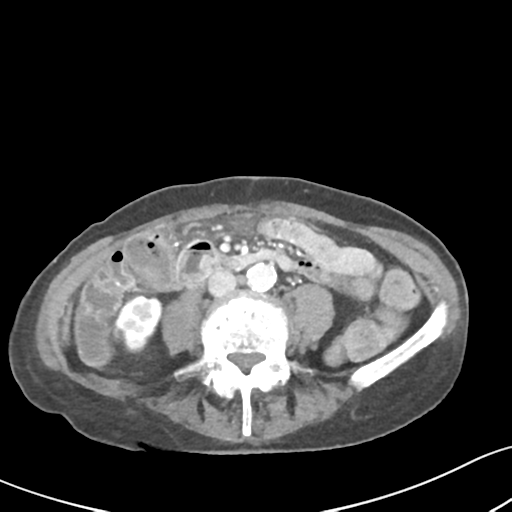 Acute cholecystitis with contained perforation (Radiopaedia 47328-51907 Axial C+ portal venous phase 41).png