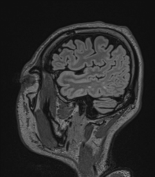 Acute disseminated encephalomyelitis (ADEM)- Anti-NMDA receptor encephalitis (Radiopaedia 54920-61201 Sagittal FLAIR 67).png