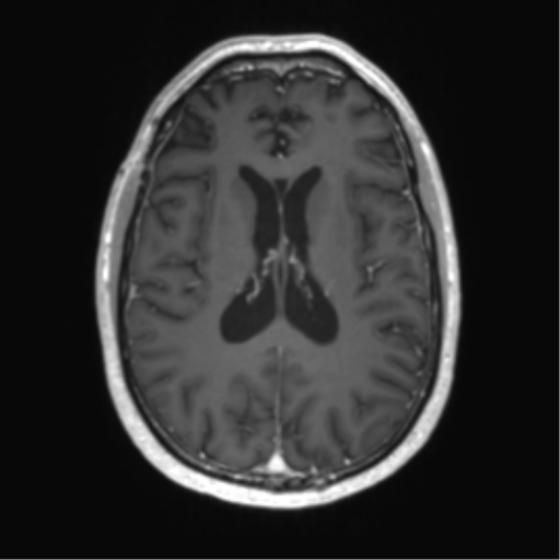 Acute disseminated encephalomyelitis (ADEM) (Radiopaedia 65319-74350 Axial T1 C+ 37).png