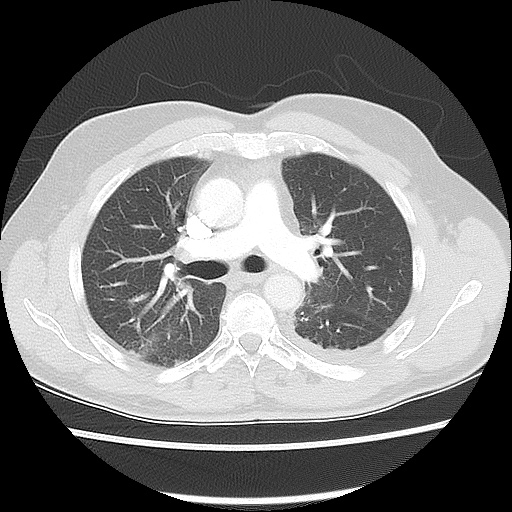 Acute epicardial fat necrosis (Radiopaedia 42327-45440 Axial lung window 26).jpg