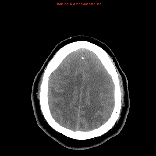 Acute hemorrhagic leukoencephalitis (Radiopaedia 14076-13920 Axial non-contrast 39).jpg