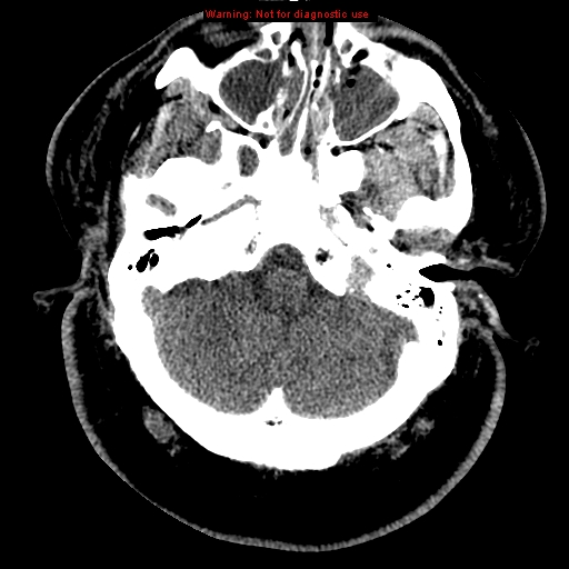 Acute hemorrhagic leukoencephalitis (Radiopaedia 14076-43697 Axial non-contrast 7).jpg