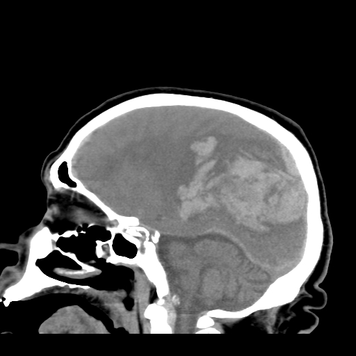 File:Acute hemorrhagic stroke (Radiopaedia 17507-17223 Sagittal non-contrast 19).jpg