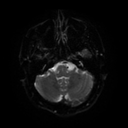 Acute internal carotid artery dissection (Radiopaedia 53541-59632 Axial DWI 38).jpg