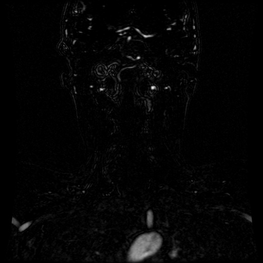 Acute internal carotid artery dissection (Radiopaedia 53541-59632 Coronal MRA 30).jpg