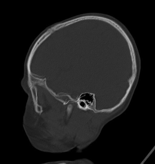 Acute mastoiditis (Radiopaedia 82678-96881 Sagittal bone window 12).jpg