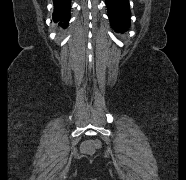 Acute mesenteric ischemia (Radiopaedia 80029-93316 Coronal C+ arterial phase 126).jpg