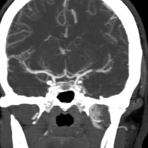 File:Acute middle cerebral arterial embolus (Radiopaedia 3956-6518 Coronal C+ arterial phase 1).jpg
