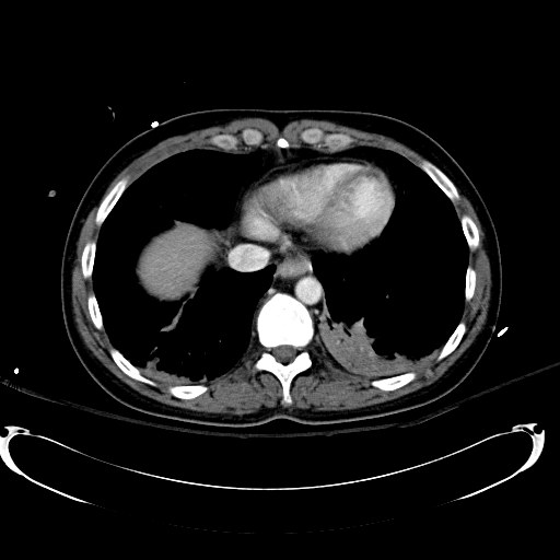 Acute myocardial infarction in CT (Radiopaedia 39947-42415 Axial C+ portal venous phase 13).jpg