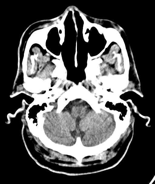 Acute on chronic subdural hematoma (Radiopaedia 78346-90966 Axial non-contrast 16).jpg