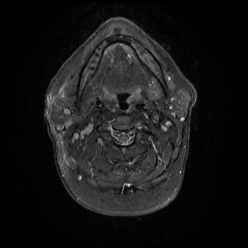File:Acute otitis externa (Radiopaedia 57296-64236 Axial STIR 17).jpg