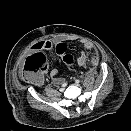 Acute pancreatic necrosis (Radiopaedia 13560-18501 Axial C+ portal venous phase 104).jpg