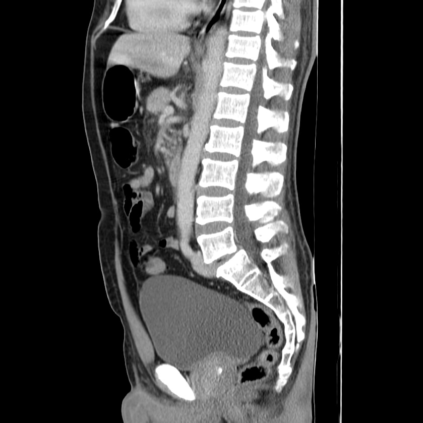Acute pancreatitis (Radiopaedia 22572-22596 Sagittal C+ portal venous phase 29).jpg