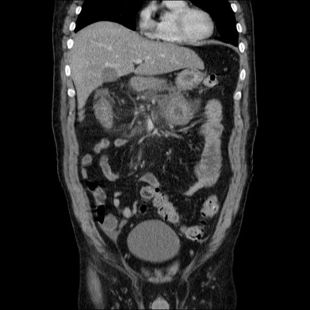 Acute pancreatitis (Radiopaedia 26663-26813 Coronal C+ portal venous phase 23).jpg